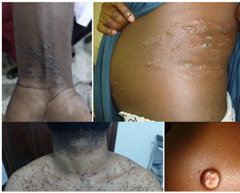 Dark Skin Lesion Study Image 2